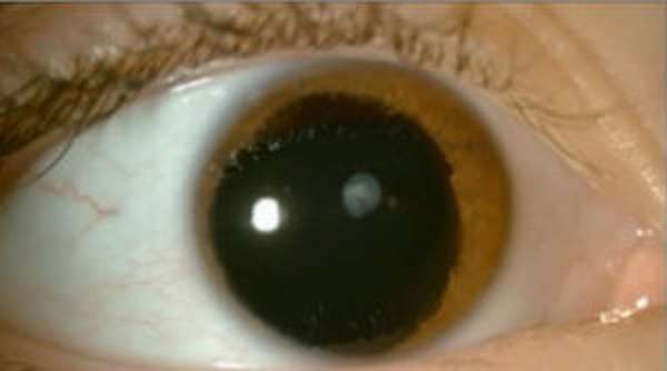 фото аниридии глаз